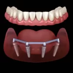 How Dental Implants Facilitate Clearer Communication in Professional and Social Settings