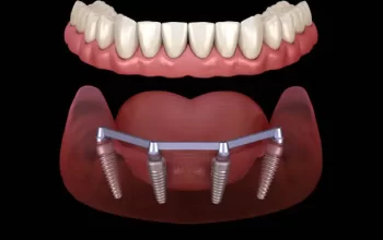 How Dental Implants Facilitate Clearer Communication in Professional and Social Settings
