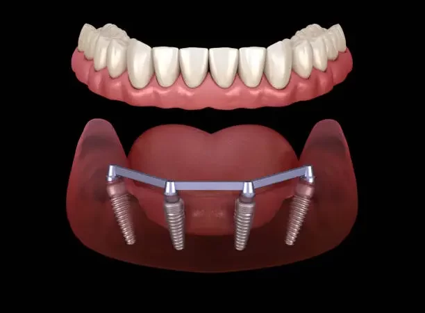 How Dental Implants Facilitate Clearer Communication in Professional and Social Settings