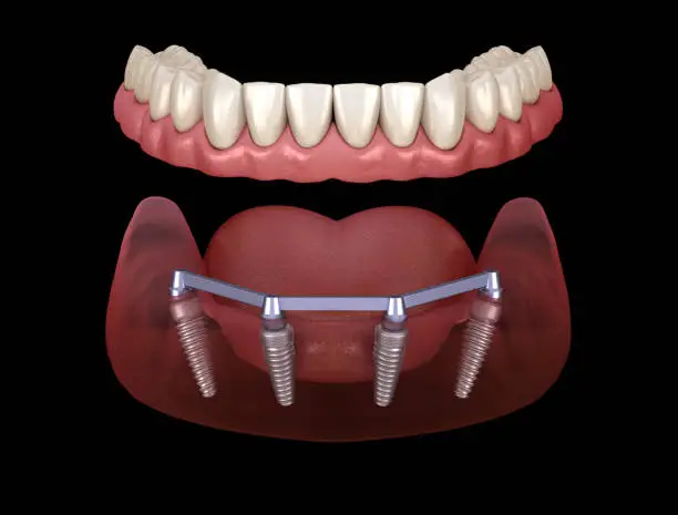 How Dental Implants Facilitate Clearer Communication in Professional and Social Settings